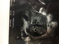 妊娠5週6日です 5週4日目に受診して胎嚢も確認してもらい２ Yahoo 知恵袋