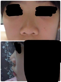 鼻筋を高くするには整形しかありませんか 小さい時から鼻筋 眉間の下 が Yahoo 知恵袋