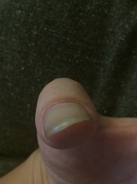 ネイルコンプレックスの質問です私の親指の爪は参考写真のように Yahoo 知恵袋