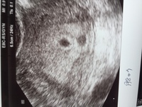 妊娠5週0日で胎嚢が確認できました もう少し待てばはっきりする事かとは Yahoo 知恵袋