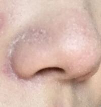 毛穴詰まりに4年悩まされている歳です 色々試しました もう一 Yahoo 知恵袋