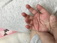 子どもの手のひらにできた赤い斑点について 一歳七ヶ月の娘がいます 先週 Yahoo 知恵袋