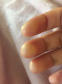 指先を火傷してしまいました 白く硬い水ぶくれになっています 自然 Yahoo 知恵袋