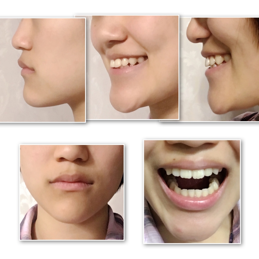 歯並びと顎の形について 横顔と歯の写真がありますので注意 口から下がし Yahoo 知恵袋