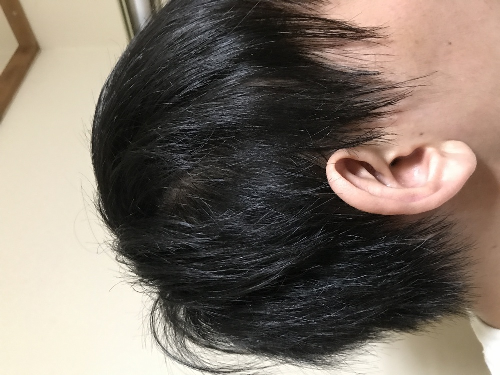 髪の側頭部が１部だけ薄く透けてしまっているのですがこれはどう Yahoo 知恵袋