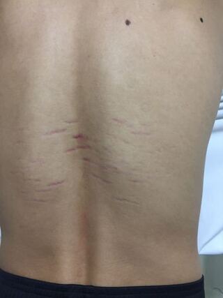 質問です 写真を見てわかる通り 今自分の背中に痣 傷 よくわからない変 Yahoo 知恵袋