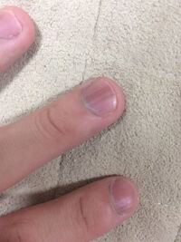 爪に黒い線があるんですけどこれってホクロですか メラノーマで Yahoo 知恵袋