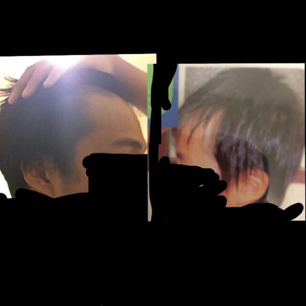 11年前と現在のおでこです これは天然剃り込みですか 後天 Yahoo 知恵袋