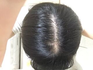 私は高2なんですけど 小学生の頃から頭頂部の髪を抜く癖があっ Yahoo 知恵袋