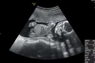 エコーの性別についてです 男の子２人のママで３人目を妊娠中です 画像は Yahoo 知恵袋