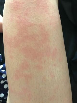 太もも 赤い 湿疹 顔 腕 足 手 お腹 背中などのかゆくない湿疹の原因は