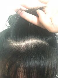 高校生です 髪と髪の間が広く髪が広いのですがこれは禿げ Yahoo 知恵袋