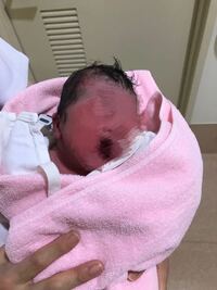 子供は昨日生まれました 帝王切開で 子供の右頭の部分が傷があって先 Yahoo 知恵袋