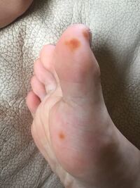足の裏に茶色のサビみたいな色のシミができています 気づいたの Yahoo 知恵袋