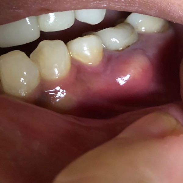 この歯茎の腫れは膿ですか？ - 押すとかなり痛いです。針を刺 