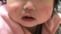 生後8ヶ月の赤ちゃんの頬にできている赤いブツブツについてです 2週間ほ Yahoo 知恵袋