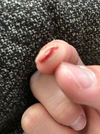 指が痛いです 爪と皮膚の間が剥がれたのではなく爪に皮膚が Yahoo 知恵袋