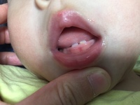 赤ちゃんの歯に歯石が 1歳0ヶ月 下の歯が二本生え始めの段階です 上 Yahoo 知恵袋