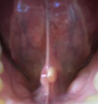 舌の裏に白いしこり みたいなのがあります さわると動き Yahoo 知恵袋