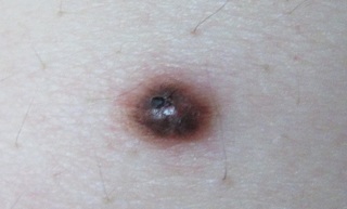 だらしない ステープル 光電 脇腹 ほくろ たくさん Kegahaeru Jp