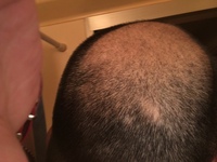 伸ばしても目立つ 坊主にしても目立つ どうしたらいいですかねぇ Yahoo Beauty