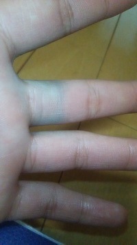 写真の通り左手の中指が青いです 青くなる前は指輪をしていました アク Yahoo 知恵袋