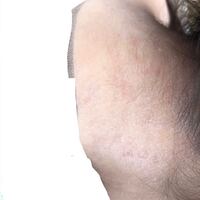 閲覧注意 襟足の皮がむける 季節を問わず ときどき画像 Yahoo 知恵袋