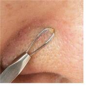 鼻の脂が止まりません 鼻から油田のように脂が出ます そのせいか鼻に Yahoo 知恵袋