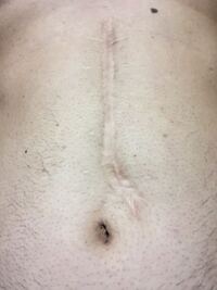 体に手術傷があり プールの時友達から セックスする時引かれるね Yahoo 知恵袋