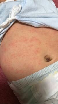 乳児湿疹について 生後2ヶ月の赤ちゃんがいます 乳児湿疹 Yahoo 知恵袋