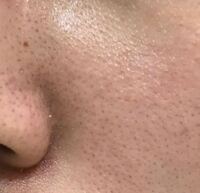 鼻の毛穴から皮脂がドバドバ出てきて毛穴が油で埋まってしまいます 簡単に Yahoo 知恵袋