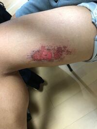 サッカーの試合中に人工芝でスライディングしてやけどしました Yahoo 知恵袋