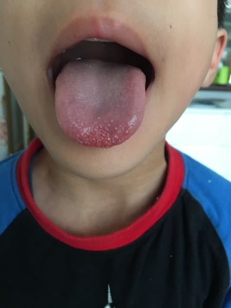 子供が舌が痛い といい見たら舌に白いブツブツができていました こ Yahoo 知恵袋
