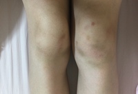 膝のあざが消えません ほんと少しだけ薄くなったのですが 1 Yahoo 知恵袋