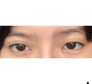 画像あり 蒙古襞 左右目が違う 美容整形 目の大きさも左右で Yahoo 知恵袋