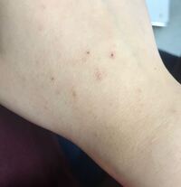 埋没毛を無理やり引っこ抜いたりしてたら手の甲から腕にかけてか Yahoo 知恵袋