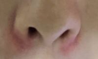 鼻の下 小鼻がずっと赤いのが悩みです 鼻の下 小鼻が写真 Yahoo 知恵袋