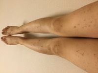 足の傷を消したいです生まれた時からアトピーで 最近では足のア Yahoo 知恵袋