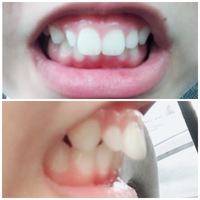 出っ歯の再矯正についてです 画像あり 現在16歳の女です 17年 Yahoo 知恵袋