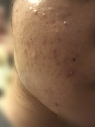 16歳の男です ニキビとニキビ跡で悩んでいます 約一年半前からニ Yahoo 知恵袋