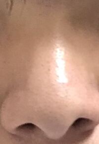 豚鼻や団子鼻についての質問なのですが自分の鼻は画像の通りでと Yahoo 知恵袋