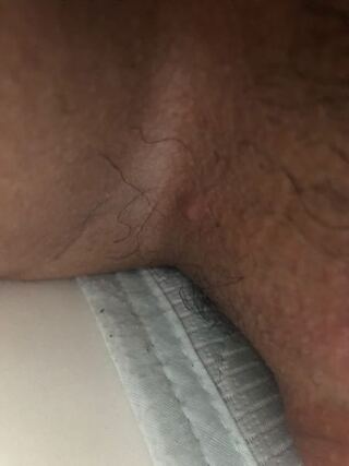 ニキビ 足 の 付け根