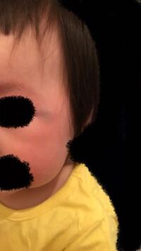 保育園に2歳の子供を迎えに行った際 目の横に青タンができていま Yahoo 知恵袋