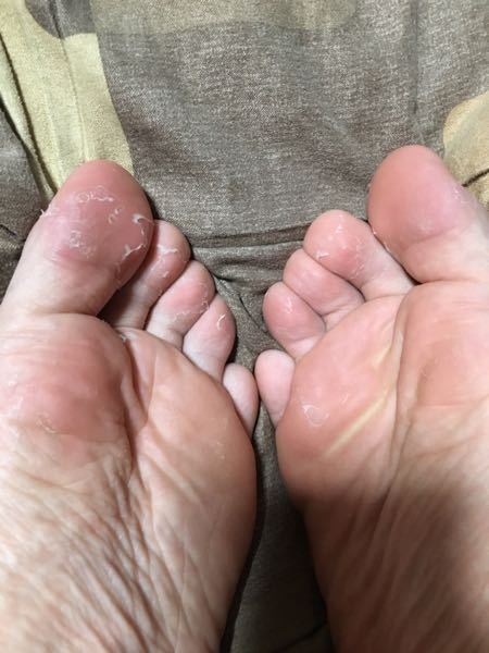 指 の 皮 が 剥ける 足の指の皮がむける原因と対処法6つ Amp Petmd Com