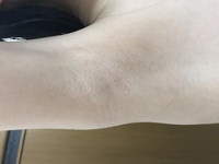 脇の毛穴から 10年ほど前に脱毛済みです ですので毛の処理は一切無い Yahoo 知恵袋