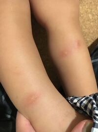 Mｒワクチン 麻疹風疹ワクチン 第２期の副反応について 年長の時に受ける Yahoo 知恵袋