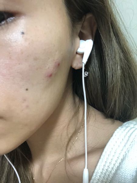 ニキビ 妊娠中 に関するq A Yahoo 知恵袋