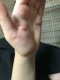 親指の付け根あたりが 山のようにボコっとなっています こ Yahoo 知恵袋