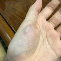 左手だけ手のひらの血管が急にボコっと出ました 指に力を入れている Yahoo 知恵袋