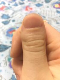 親の遺伝で親指の爪の形がこんなですり 削ったり切ったりしても中々治りませ Yahoo 知恵袋
